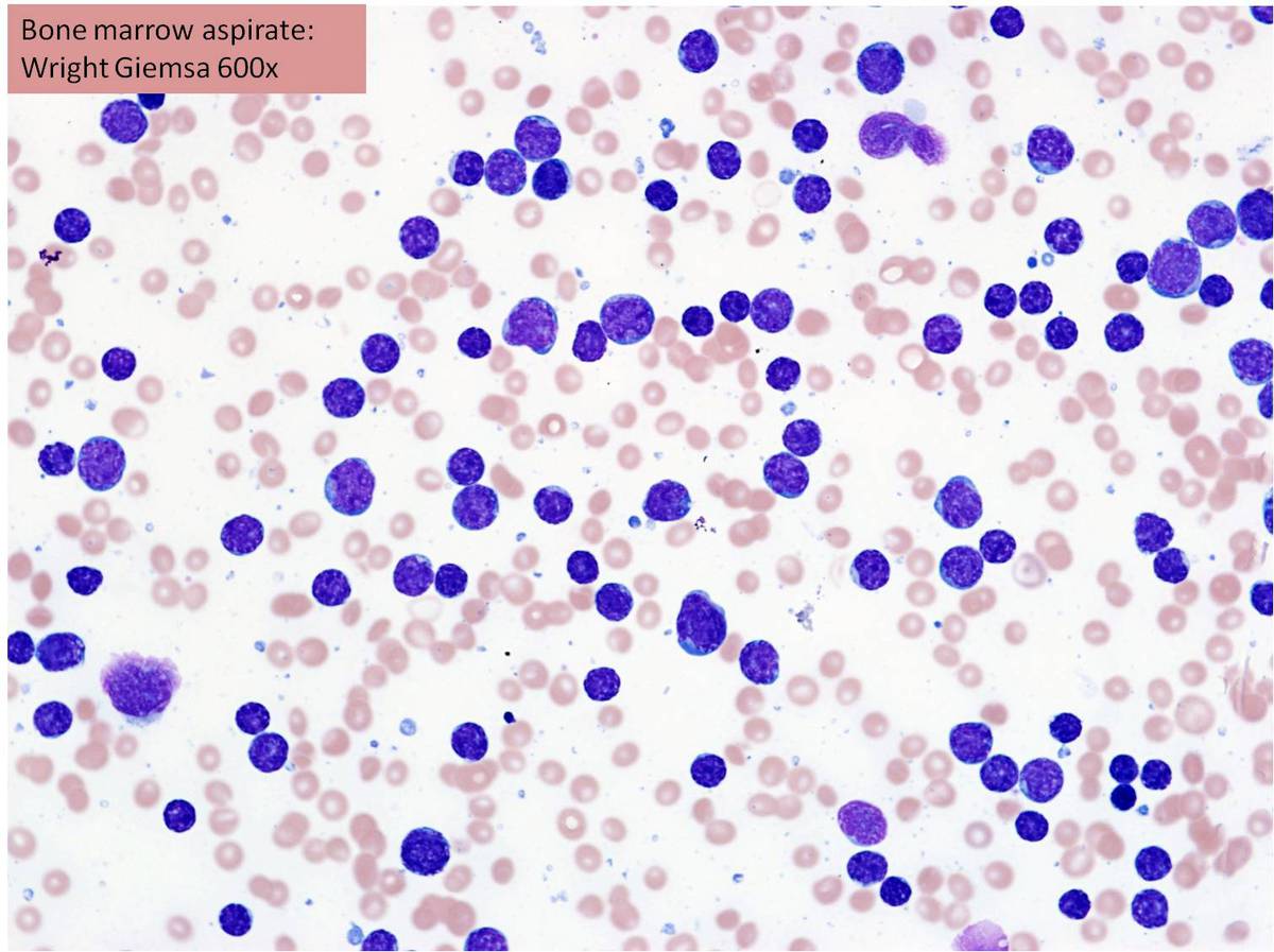 Bone marrow aspirate showing >90% lymphoblasts.